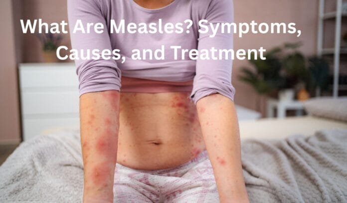 What Are Measles Symptoms, Causes, and Treatment